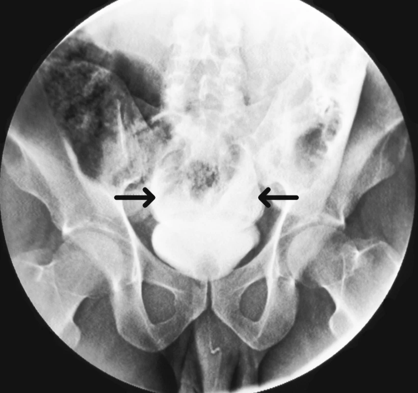 Retrográdní cystogram prokazující únik kontrastní látky do peritoneální dutiny (označeno šipkami)
Fig. 1. Retrograde cystogram showing leak of contrast into the peritoneal cavity (arrows)
