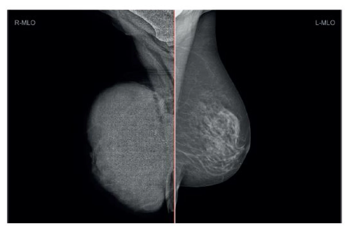 Maligní fyloidní tumor pravého prsu – anamnéza 5 let, váha 4000g, karcinom levého prsu
Fig. 6: Malignant phyllodes tumour of the right breast – history of five years, weight of 4000 grams, carcinoma of the left breast
