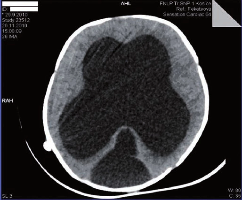 CT mozgu: výrazná dilatácia supratentoriálnych oddielov komorového systému a redukcia mozgového parenchýmu.
Fig. 1. Brain CT: marked dilation of supratentorial parts of the chamber system and reduction of the brain parenchyma.
