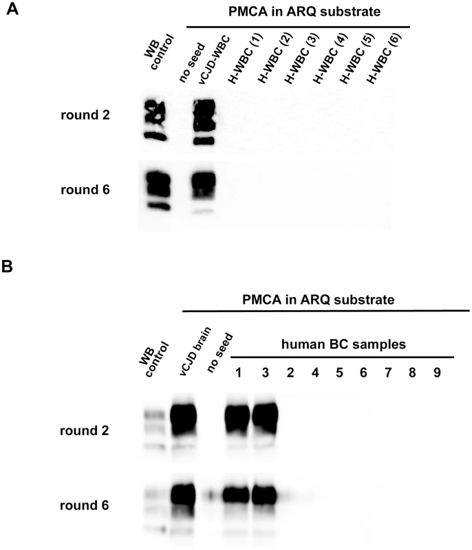 PrP<sup>res</sup> in PMCA reactions seeded with WBC or BC from a vCJD affected patients and healthy controls.