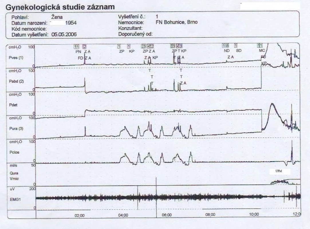 Záznam UD vyšetření levého močového měchýře.