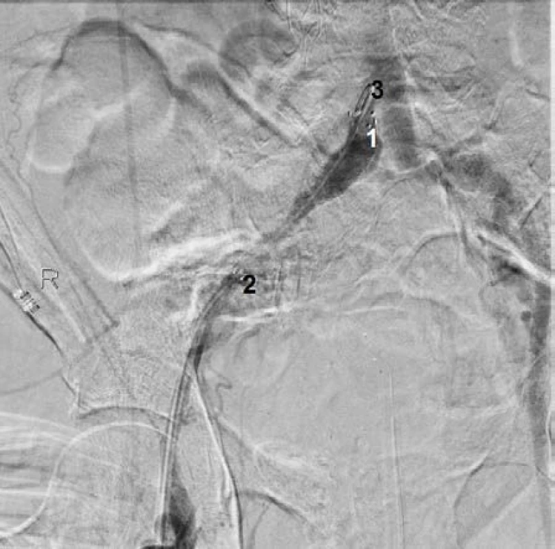 Poloha stent graftu v ilické tepně vpravo. 1) Začátek stent graftu, 2) konec stent graftu, 3) katétr ve společné ilické tepně vpravo
Fig. 4 Location of the stent graft of iliac artery (right). 1) the beginning of the stent graft, 2) the end of the stent graft, 3) catheter in the common iliac artery (right)