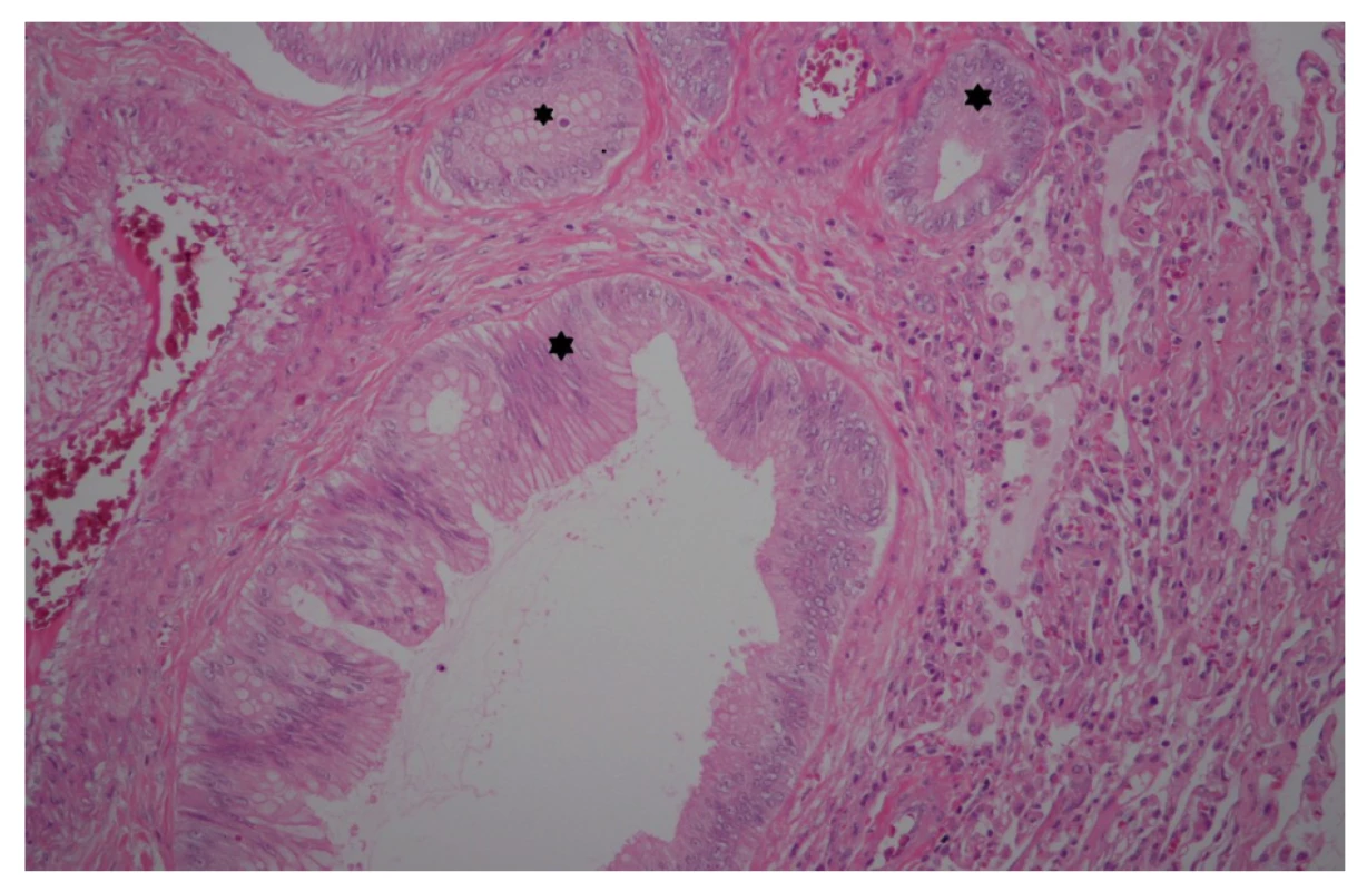 Histologický řez ložiskem v levé plíci, hematoxylin-
eosin<br>
Hvězdičky označují ložiska tumoru.<br>
Fig. 4: Biopsy section of the left lung focus, HE staining<br>
Stars indicate the tumour foci.