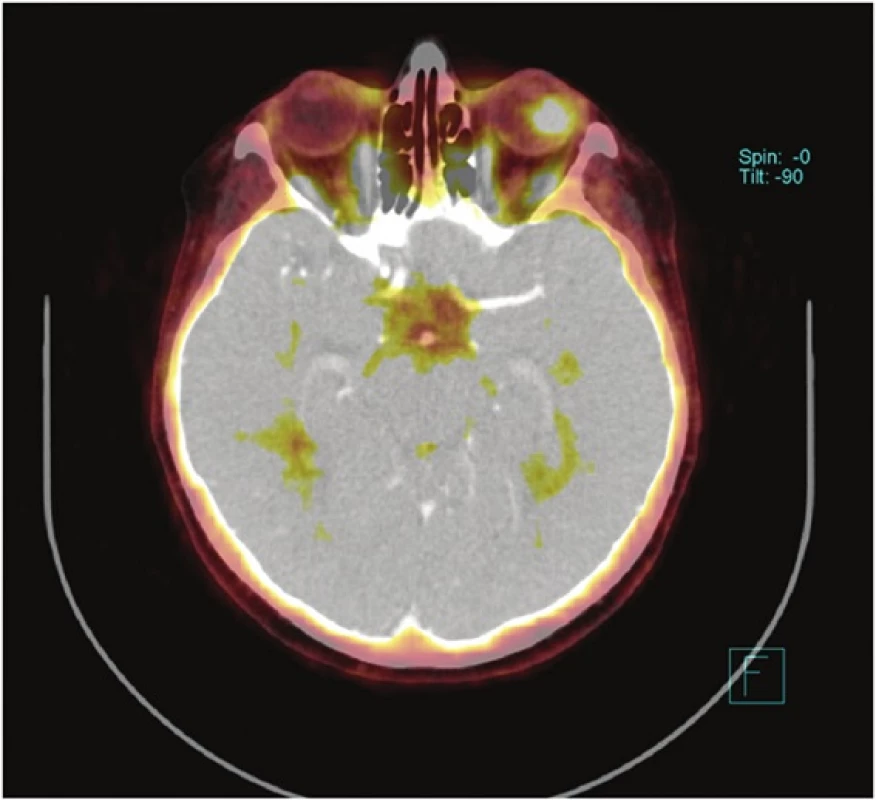 PET CT − Uveální forma maligního melanomu
Fig. 1: PET CT − Uveal form of melanoma