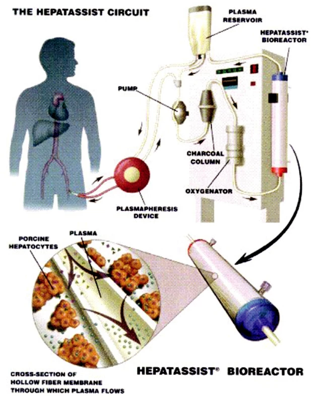 Schéma zapojení systému HepatAssist® (převzato z informačního letáku).
Fig. 3. The HepatAssist® system integration scheme (adopted from its information leaflet).