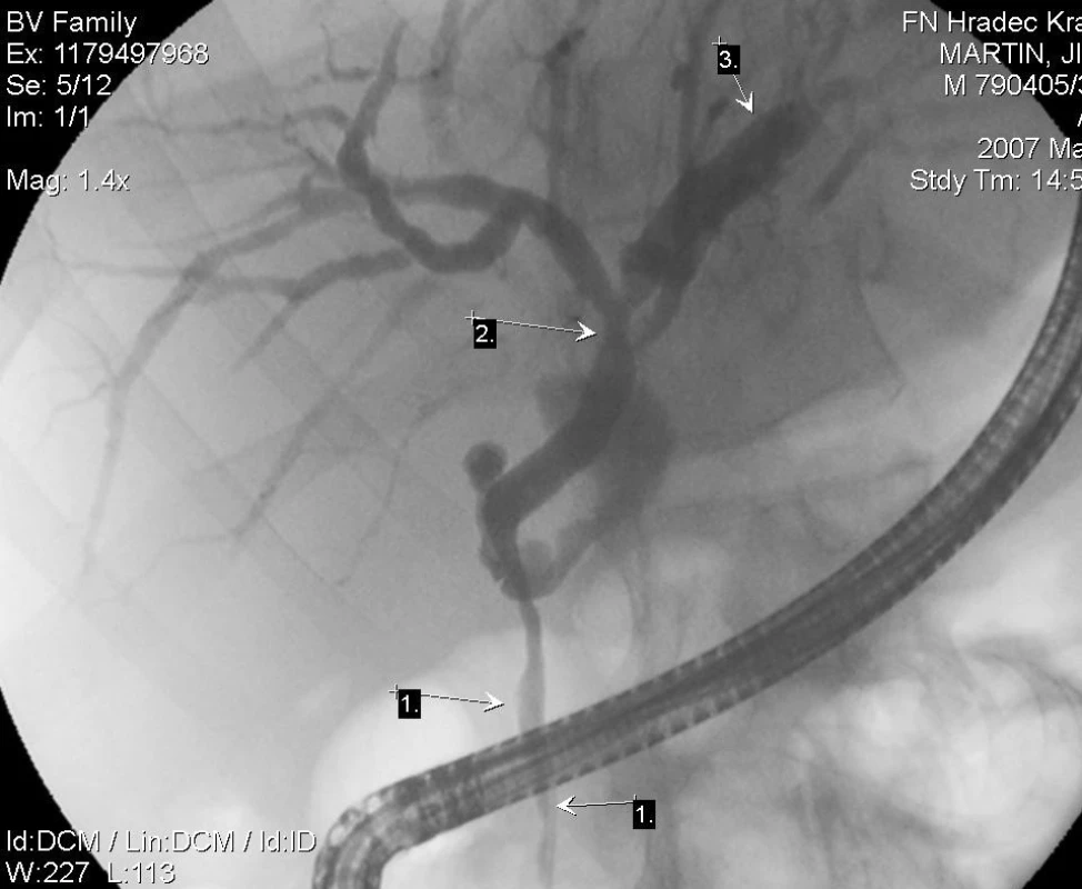 ERCP s obrazem pseudocholangiogenního karcinomu s nepravidelným, stenotickým lumen choledochu (1), další stenóza je v hilu jater (2), s mírnou intrahepatickou biliární dilatací více vlevo (3)