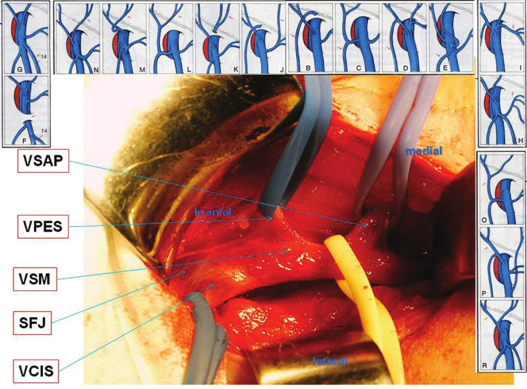 Anatomie SFJ
Fig. 8. SFJ anatomy