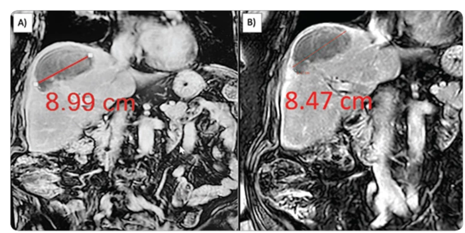  Post-procedural follow-up imaging in 3-month (A) and 6-month MRI evaluations (B) indicating complete response. 