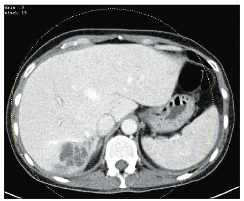 CT obraz dilatace žlučových cest v 6. jaterním segmentu
Fig. 1. CT image of bile duct dilatation in the 6th hepatic segment