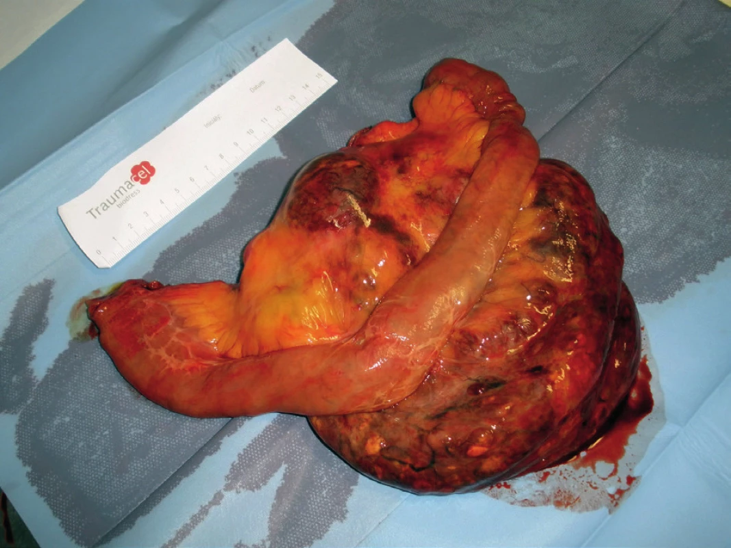 Resekát jejuna s GIST
Fig. 6: Resection specimen of jejunum with the GIST
