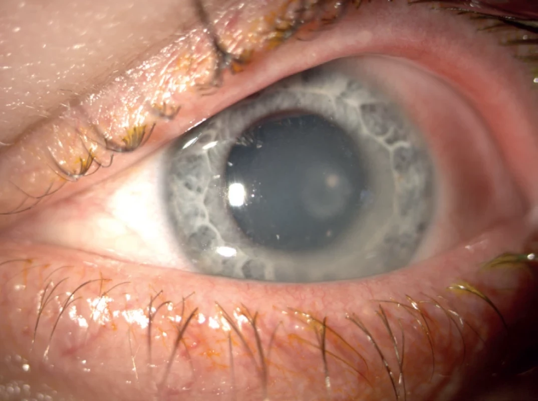Disciform keratitis caused by herpes simplex virus