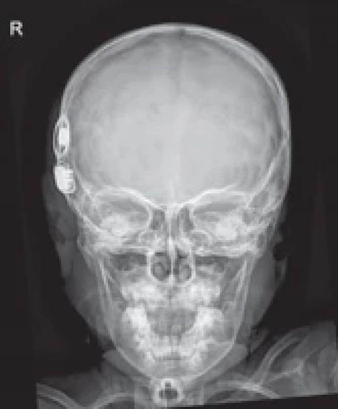 Poloha svazku elektrod po kochleární implantaci vpravo. Position of electrode bundle after cochlerar implantation on the right side.