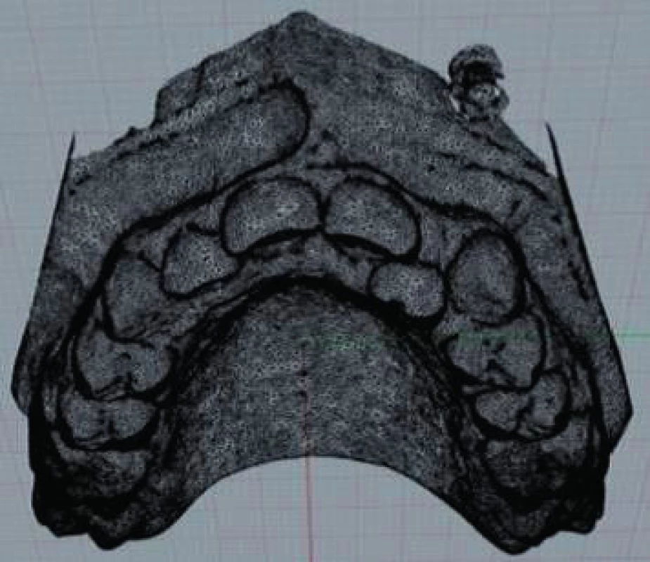 Digitální model ve formě polygonální sítě („drátěný model“) (s laskavým souhlasem MDDr. Kateřiny Mazurové, Ph.D., převzato z: Mazurová, K.: Digitální ortodontické modely. Atestační práce. Olomouc, 2013)