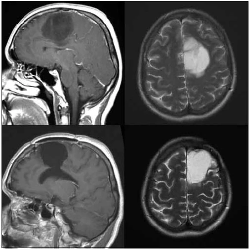 42letá pacientka po radikální > 90% resekci oligoastrocytomu gr. II v oblasti gyrus frontalis superior, gyrus
cinguli a corpus callosum vlevo v roce 2007.