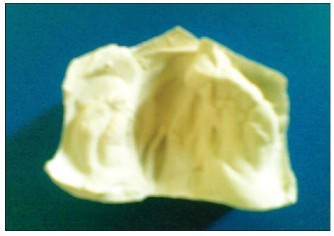Čeľustnoortodontický odtlačok; Foto: S. Valentová-Strenáčiková
Fig. 2. Orthodontic mold; Photo: S. Valentová-Strenáčiková