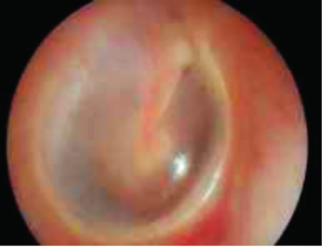 Normální ušní bubínek.
Fig. 1. Normal tympanic membrane.