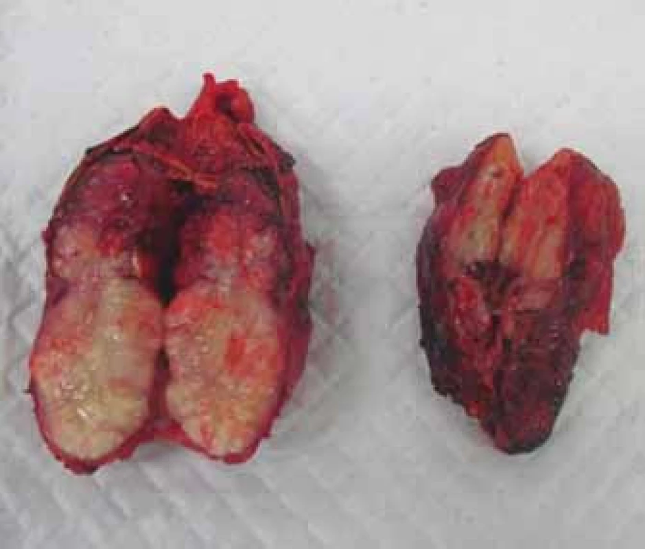 Metastázy obou nadledvin – fotografie preparátu.
Fig. 6 Metastases in both suprarenal glands – photo of the resection specimen.