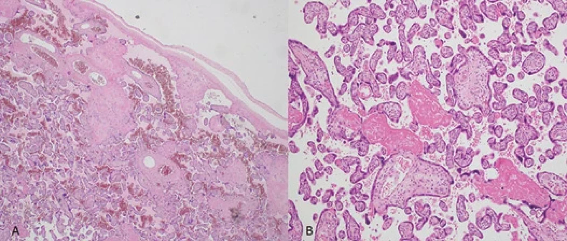 Histological examination of the placenta showed thinned and stacked hypercapilarized villi with syncitial buds and foci of fi brinoid necrosis in the presence of hyaline streaks on both maternal (A) and fetal (B) sides (Hematoxylin Eosin, HPF ×100). </br>Obr. 4. Histologické vyšetření placenty ukázalo ztenčené a na sebe navrstvené hyperkapilarizované klky se syncitiálními pupeny a ložisky fi brinoidní nekrózy v přítomnosti hyalinních pruhů na mateřské (A) i fetální (B) straně (hematoxylin eozin, HPF ×100).