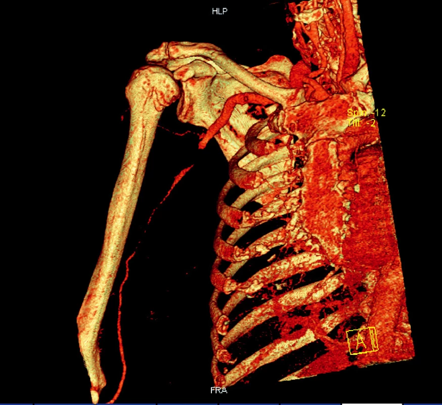 3D CT angiografie po repozici s patrnou okluzí 3. segmentu arteria axillaris
Fig. 2. 3D CT angiography following repositioning with marked occlusion of the 3rd segment of the axillary artery