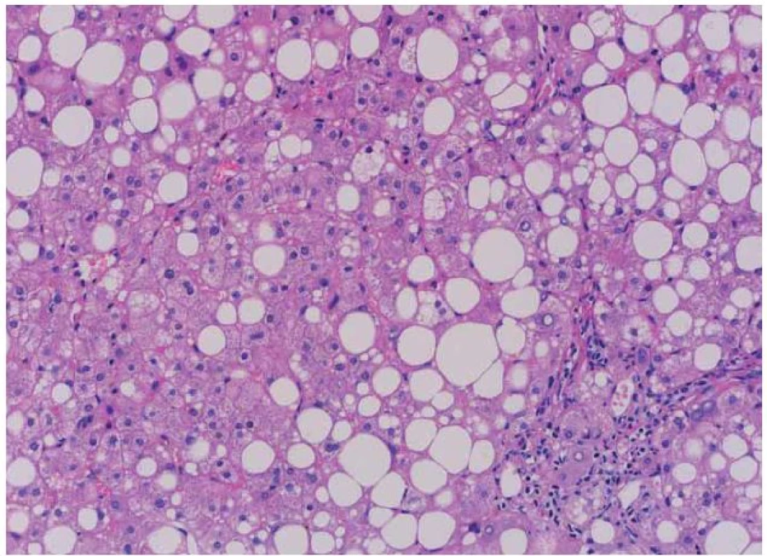 Typický histologický obraz NASH (hemoatoxylin-eozin). Je patrná steatóza, balooning hepatocytů a fibróza. (Laskavě zapůjčeno as. MUDr. J. Stříteským, CSc. – Patologicko-anatomický ústav, 1. LF UK v Praze).
Fig. 1. The typical histological picture of NASH (hematoxylin-eosin). Mixed steatosis, ballooning hepatocytes and fibrosis are evident. (Courtesy of J. Stříteský, MD, PhD. – Department of Pathology and Anatomy, 1<sup>st</sup> Faculty of Medicine, Charles University in Prague).