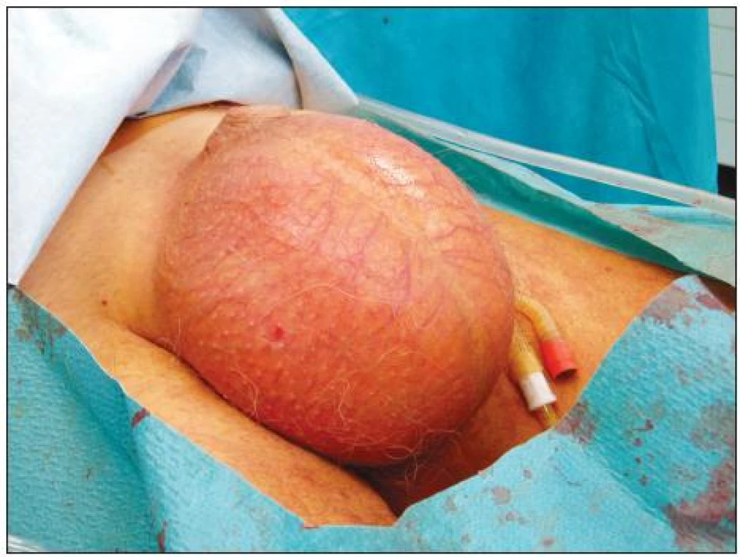 Pneumoskrotum před drenáží
Fig. 1. Pneumoscrotum before drainage