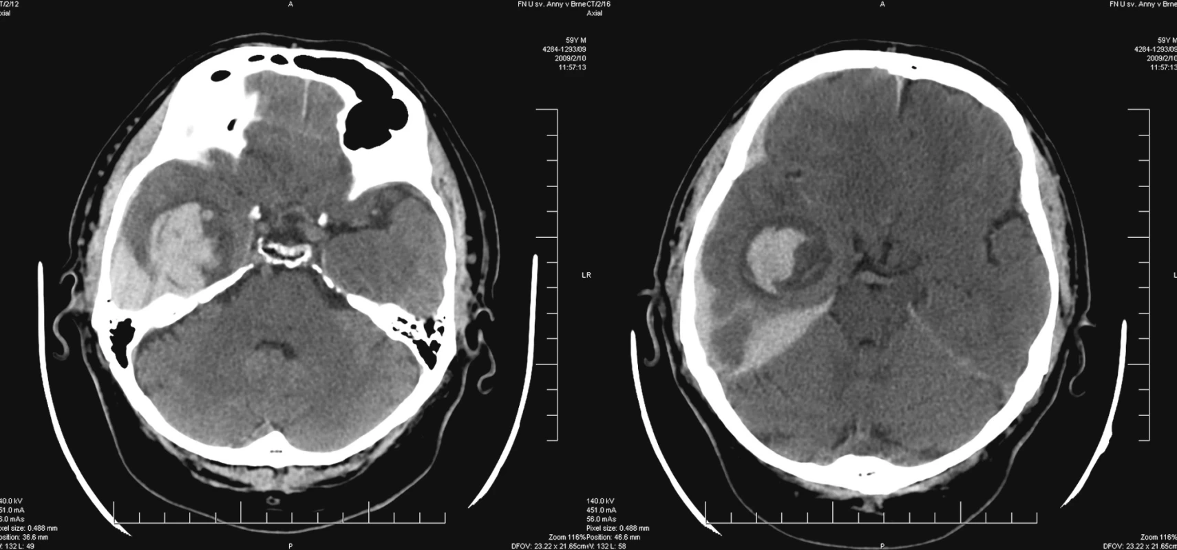 CT obraz intracerebrálního hematomu v hloubce temporálního laloku vpravo s provalením subdurálně
Pic. 1. CT – intracerebral haematoma in the depth of temporal lobe with subdural penetration