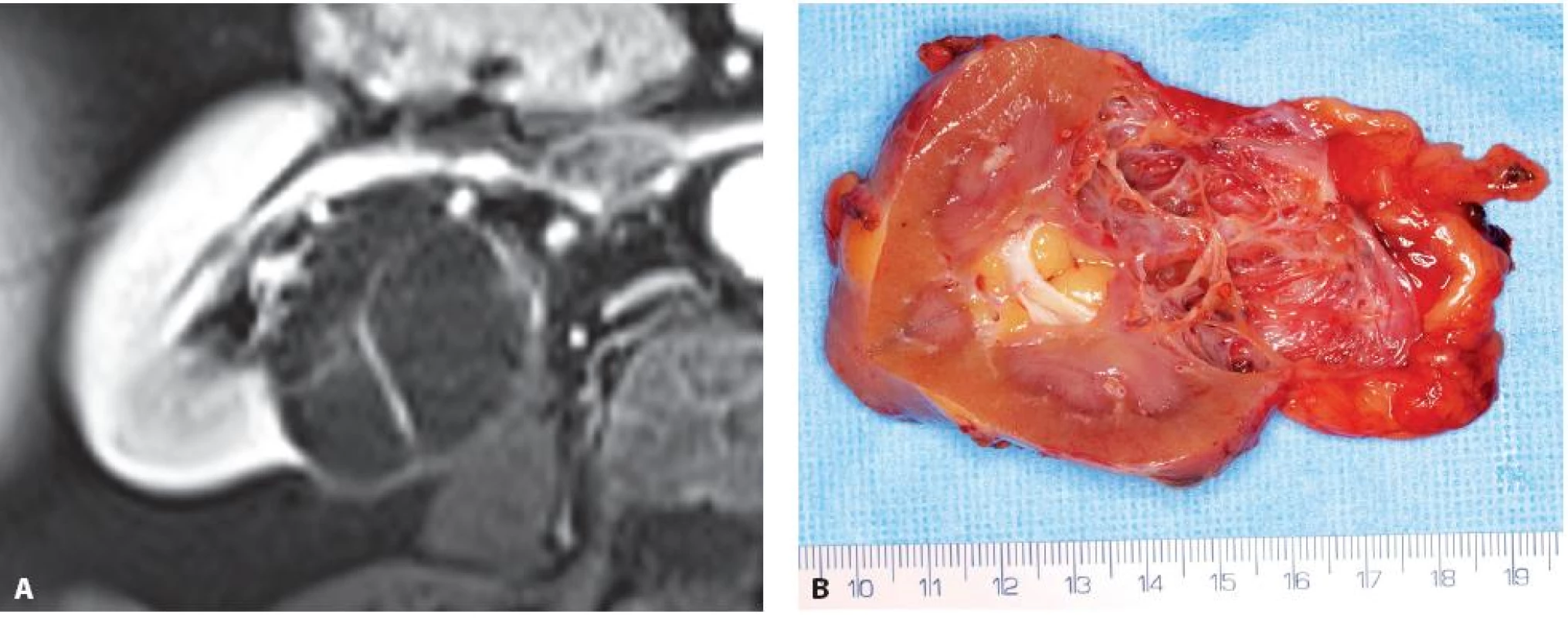 Multicystický světlobuněčný renální karcinom zadního rtu pravé ledviny. A – MRI, B – nativní preparát
Fig. 5. Multicystic clear cell renal cell carcinoma. A – MRI, B – specimen at operation