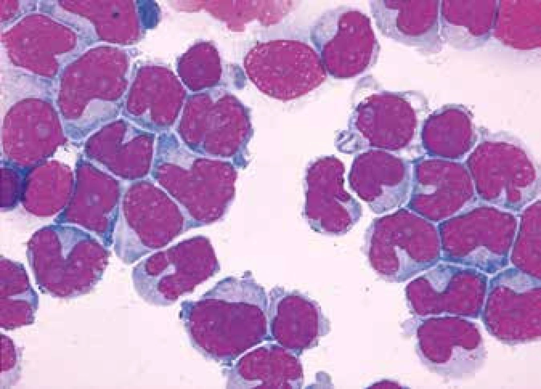 CD5+ MZL, pleomorfní obraz (středně velké anizomorfní lymfocyty s bohatou 
a nepravidelnou bazofilní cytoplazmou, méně kondenzovaným jaderným chromatinem a zřetelnými vícečetnými nukleoly a mikronukleoly)