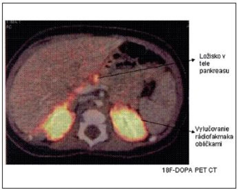 <sup>18</sup>F-DOPA PET CT scan s nálezom fokálnej lézie tela pankreasu. (Barthlen, JCEM 2008)