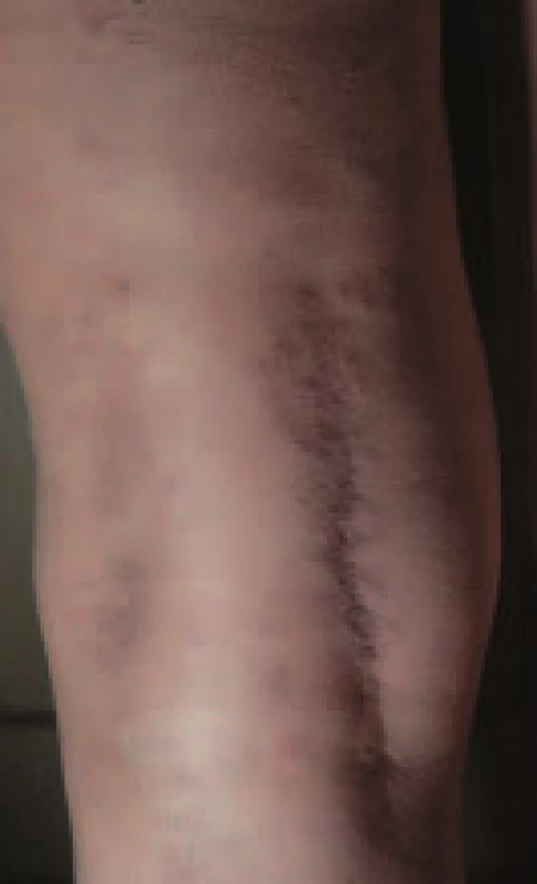 Granuloma annulare.