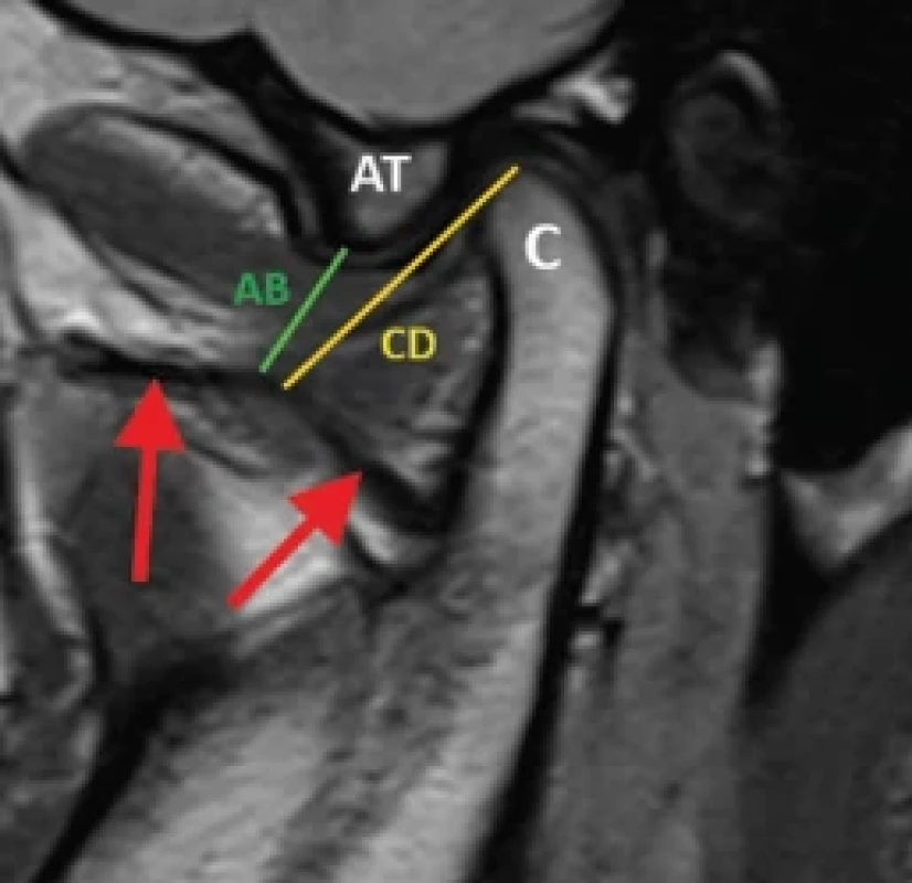 MRI of the temporomandibular joint, parasagital view. 