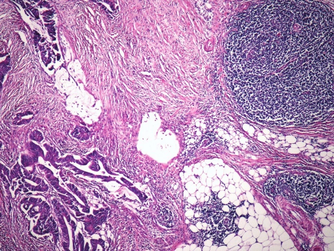 Kazuistika 2 – adenokarcinom tlustého střeva s navazující infiltrací malobuněčným B-lymfomem CLL/SLL (HE, 10x)
Fig. 4: Case 2 – colonic adenocarcinoma with subsequent infiltration by small cell B-cell lymphoma CLL/SLL (HE, 10x)