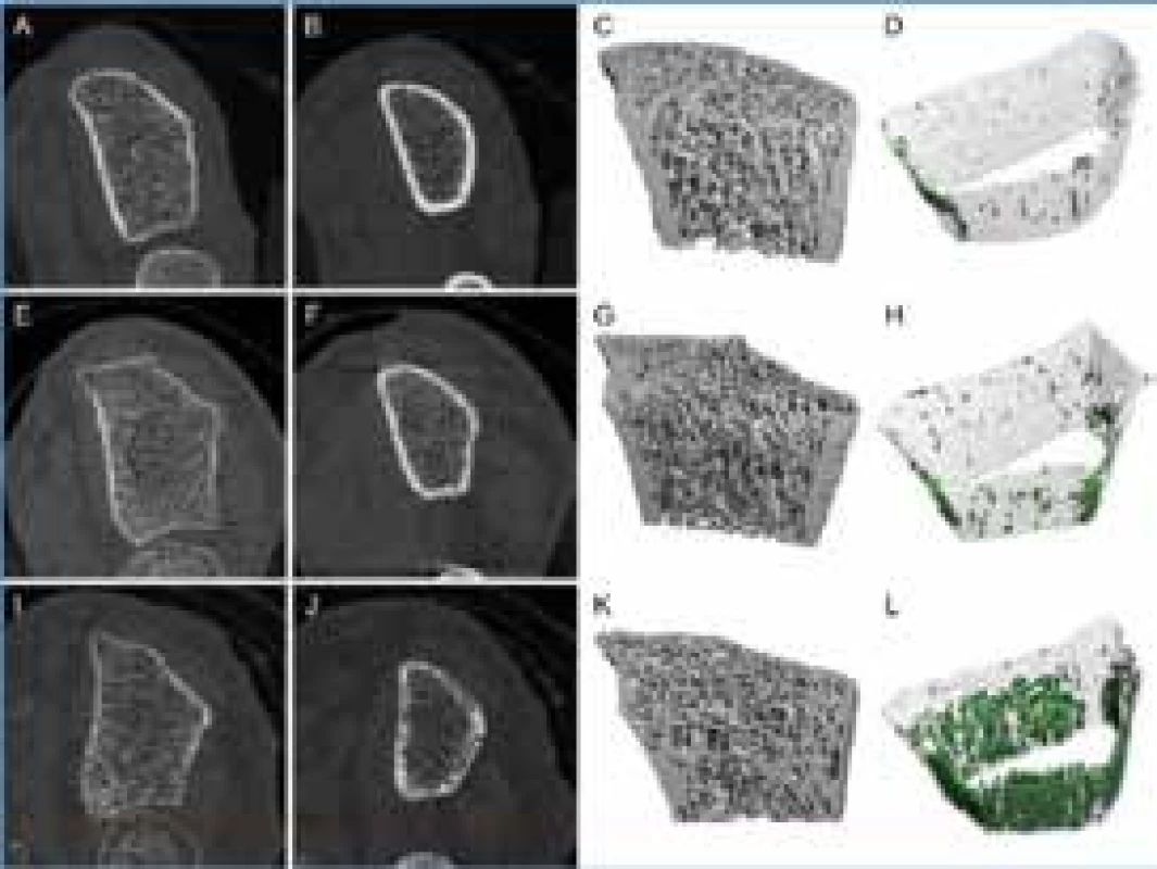 Kvantitativní CT vyšetření s vysokým rozlišením – HRqCT distální (A, E, I) a proximální části (B, F, J) radia, 3D rekonstrukce (C, G, K) a vizualizace kortikální kosti (D, H, L)