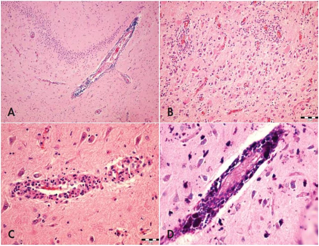 (A) Gyrus parahippocampalis. Je zachytená reaktívna glióza a výrazný perivaskulárny zápalový infiltrát, hematoxylín-eozín, zväčšenie 100 krát. (B) Reaktívna glióza a perivaskulárne zápalové infiltráty, hematoxylín-eozín, zväčšenie 200 krát. (C) Perivaskulárne penovité makrofágy, hematoxylín-eozín, zväčšenie 400 krát. (D) PAS pozitívne makrofágy prítomné nielen perivaskulárne ale aj voľne v parenchýme, PAS, zväčšenie 400krát.