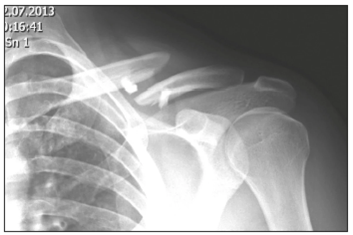 Selhání osteosyntézy s prodlouženým hojením
