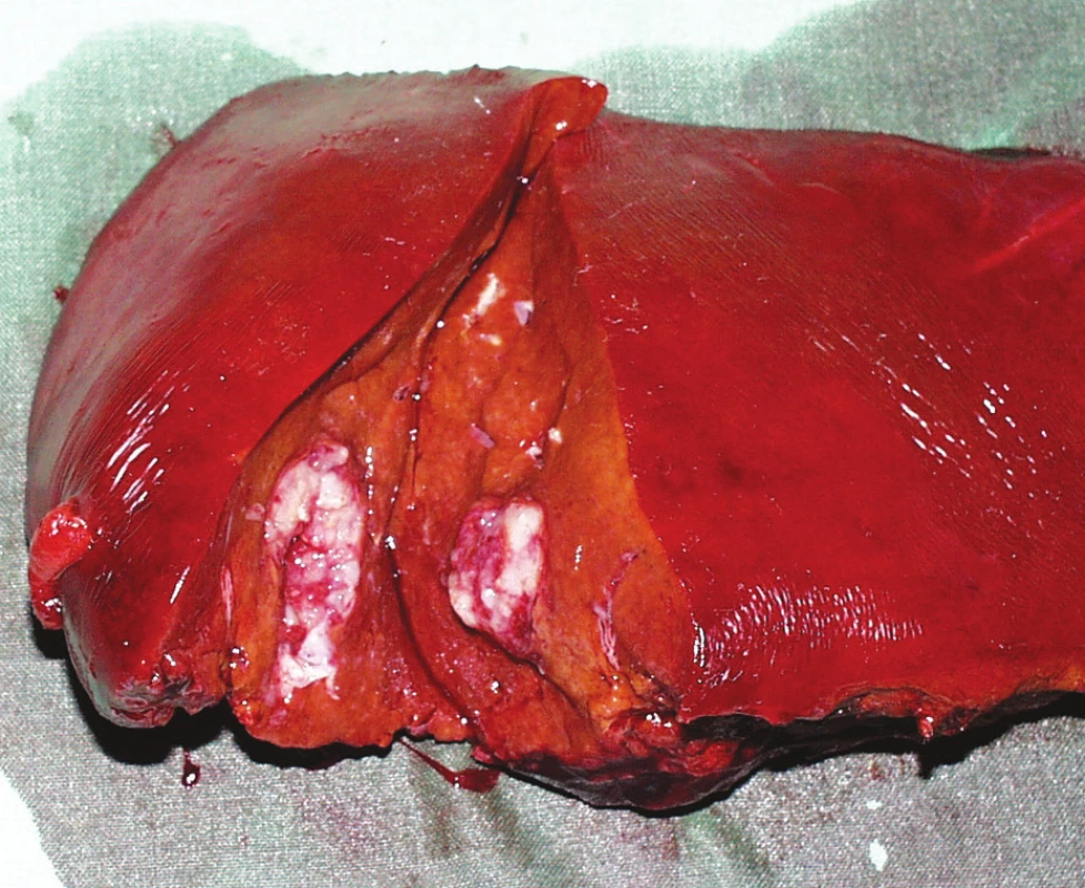 Metastáza karcinomu prsu v pravém jaterním laloku
Fig. 2. Breast carcinoma metastasis in the right liver lobe