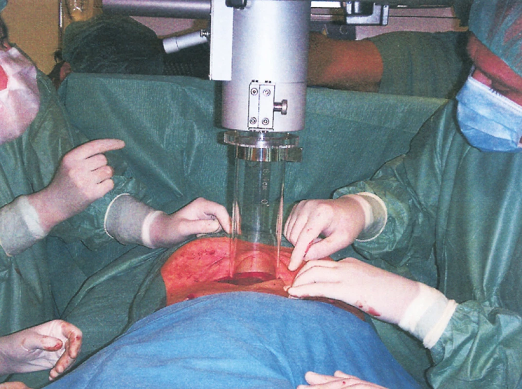 Intraoperační radioterapie sarkomu retroperitonea s použitím elektronového svazku lineárního urychlovače – umístění tubusu pro IORT do břišní dutiny
Fig. 5. Intraoperative radiotherapy of the retroperitoneal sarkoma using an electron beam linear accelerator– positioning of the tubus for abdominal IORT