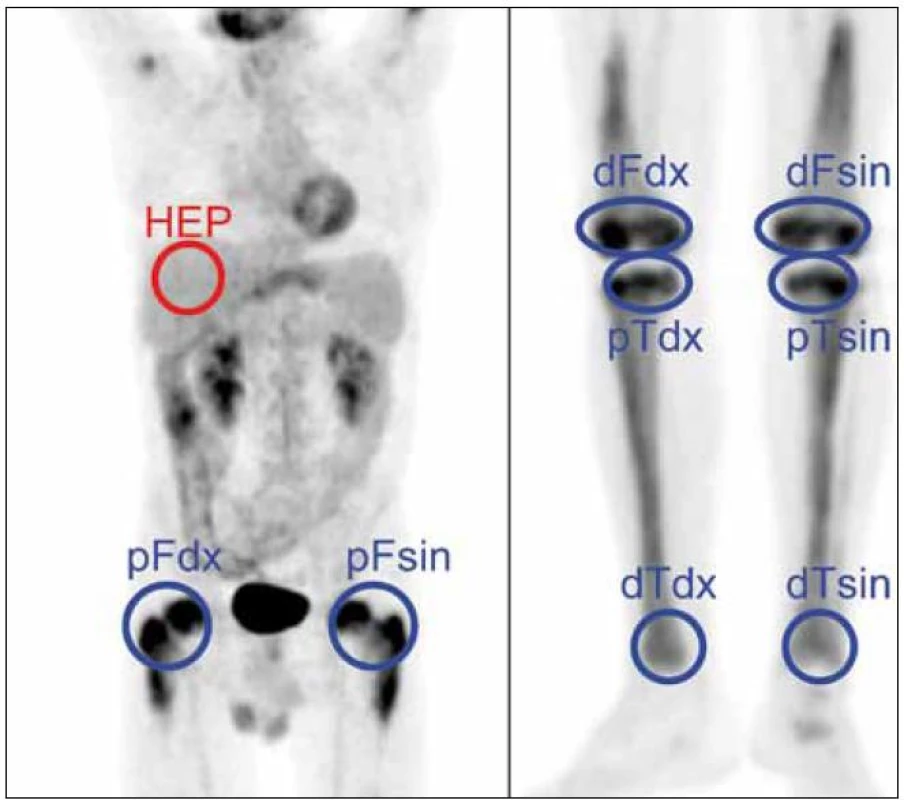 Metodika měření metabolické aktivity ve stanovených místech skeletu a referenčním parenchymu jater: index metabolické aktivity SUV<sub>max</sub> stanovujeme u všech studií v proximálních femurech, distálních femurech, proximálních i distálních tibích oboustranně a v játrech (referenční oblast), na rozdíl od obrázku ne ve 2D, ale ve 3D analýze.