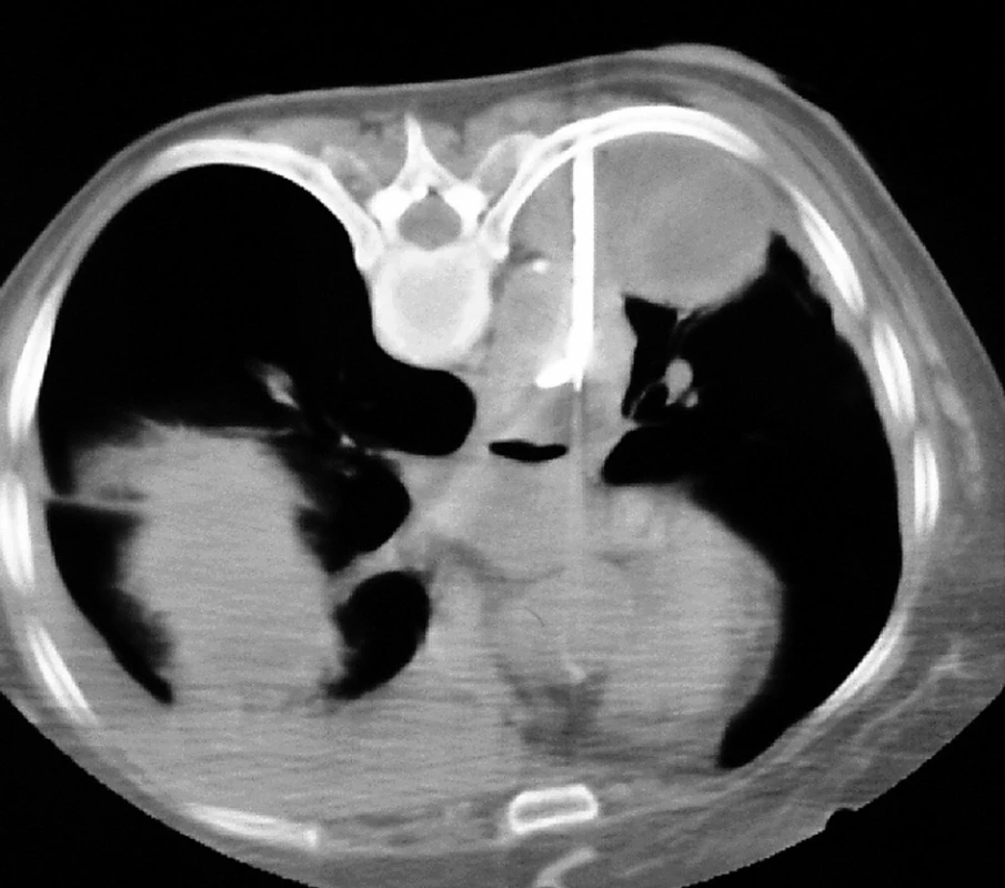 Chybné zavedení hrudního drénu: a) do plíce; b) přes aortu
Fig. 6: Misplacements of the chest drain: a) into the lung; b) through the aorta