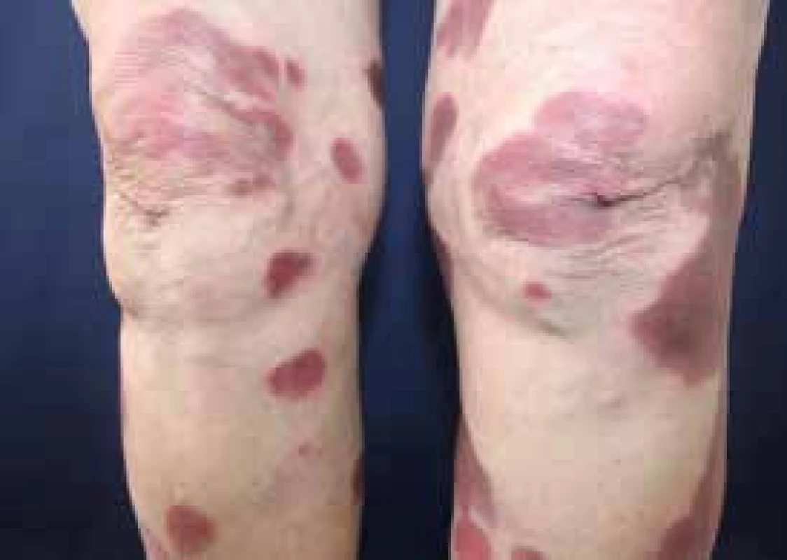 Necrobiosis lipoidica