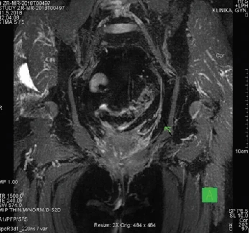 NMR obraz pudendálního nervu s pooperační fi brózou (označeno šipkou). Fig. 3. NMR image of the pudendal nerve with postoperative fi brosis (indicated by an arrow).