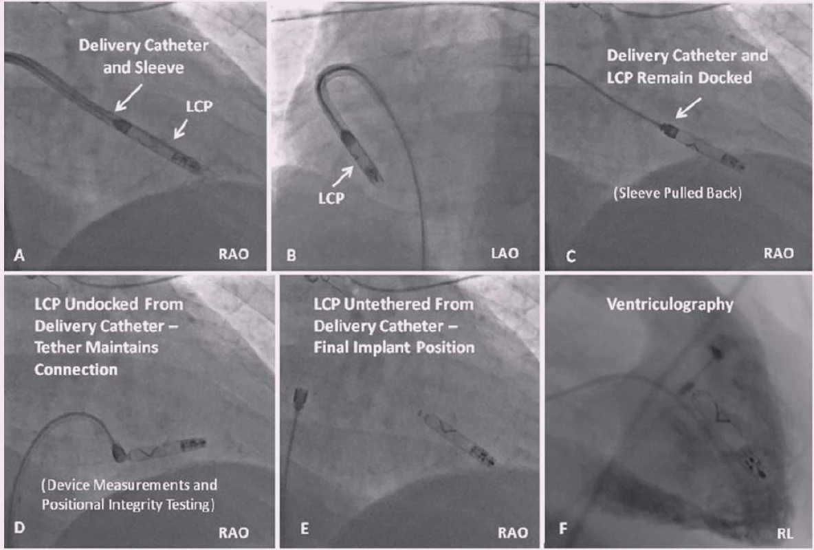 RTG snímek postupu implantace LCP Nanostim se zavedeným katetrem v oblasti apikoseptální oblasti PK s viditelným převlečným pouzdrem a) v RAO a b) LAO projekci; c) tentýž systém pak bez převlečného pouzdra připravený k implantaci; d) schema prováděného testu stability LCP po jeho ukotvení ve stěně PK; e) již odpojený vodící katetr, LCP zůstává fixován v původní pozici; f) kontrastní nástřik PK s průkazem optimální polohy LCP. Převzato z [31].