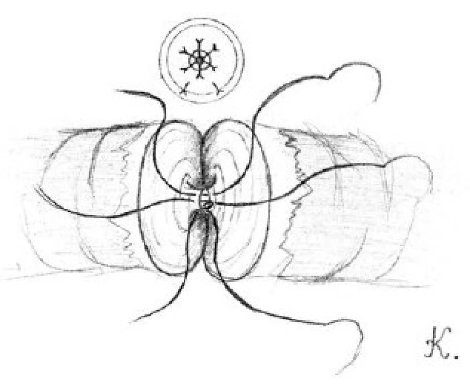 Přiblížení přední slizniční vrstvy obou konců chámovodu pomocí tří dvojitých 10-0 nylonových stehů
Fig. 2. The approximation of the anterior mucosal layers for both ends of vas deferens with tree double armed 10-0 nylon sutures