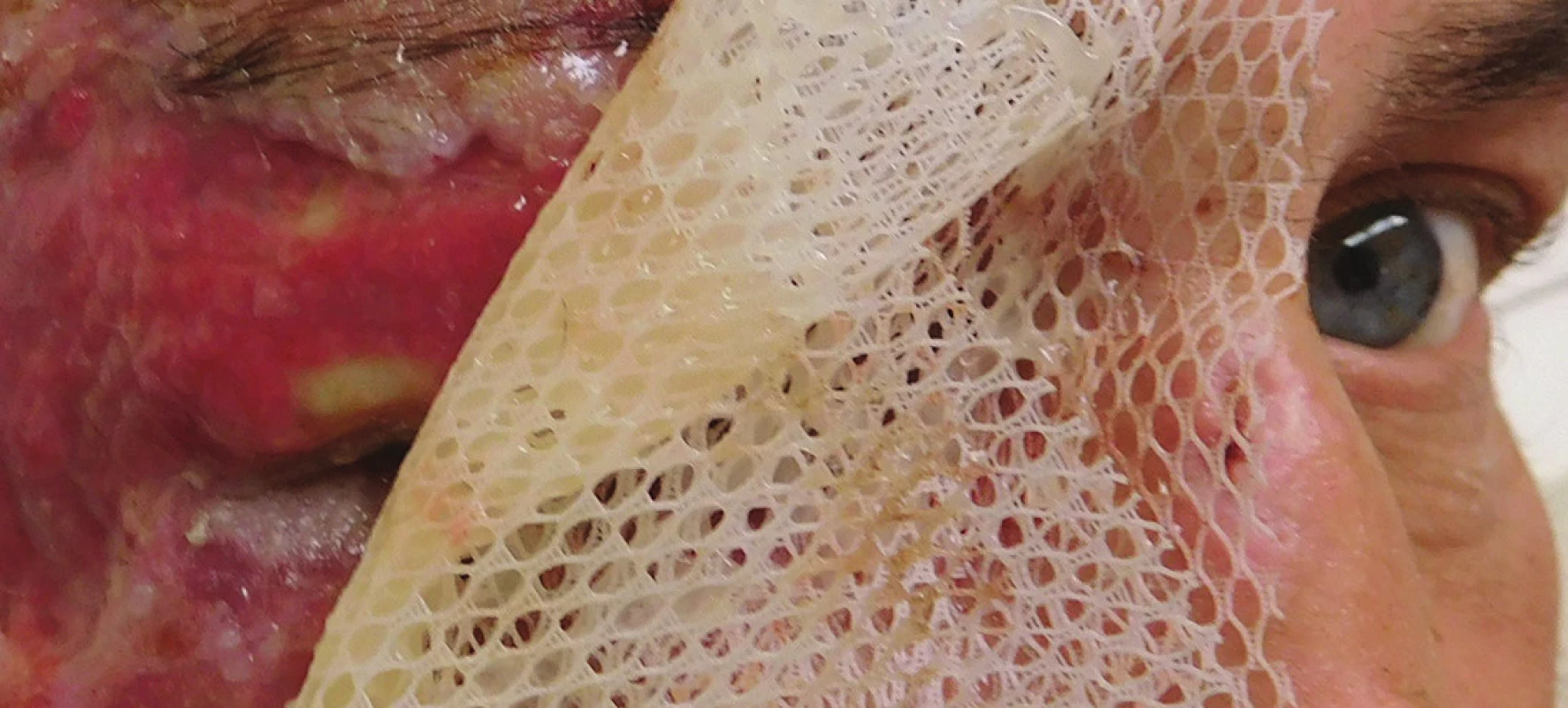 Priebeh hojenia pod aplikáciou mastného tylu