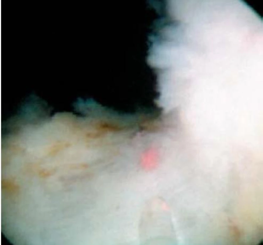 Holmium Laser Enucleation of the Prostate (HoLEP).