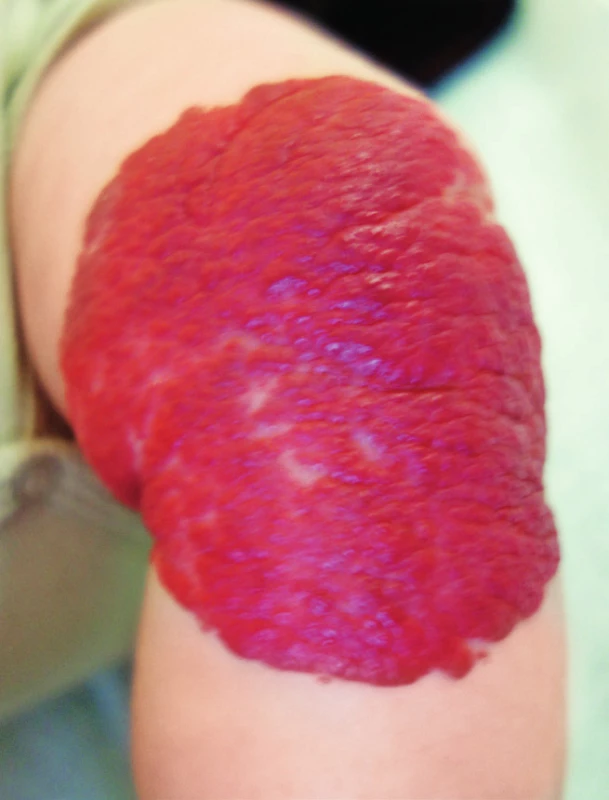 Superficiální hemangiom.
Fig. 4. Superficial hemangioma.