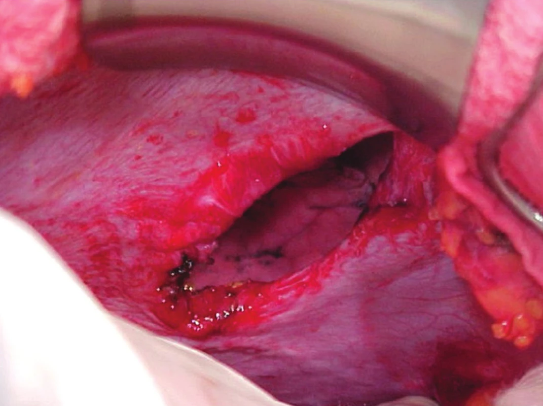 Stav po repozici žaludku
Fig. 2: Condition after reposition of the stomach