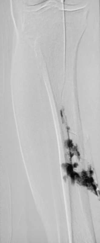 Perforácia arteria fibularis na pravom predkolení hydrofilným vodičom s extravazáciou kontrastnej látky
Fig. 5. Perforation of the right fibular artery using a hydrophilic coated guidwire with the contrast matter extravasation
