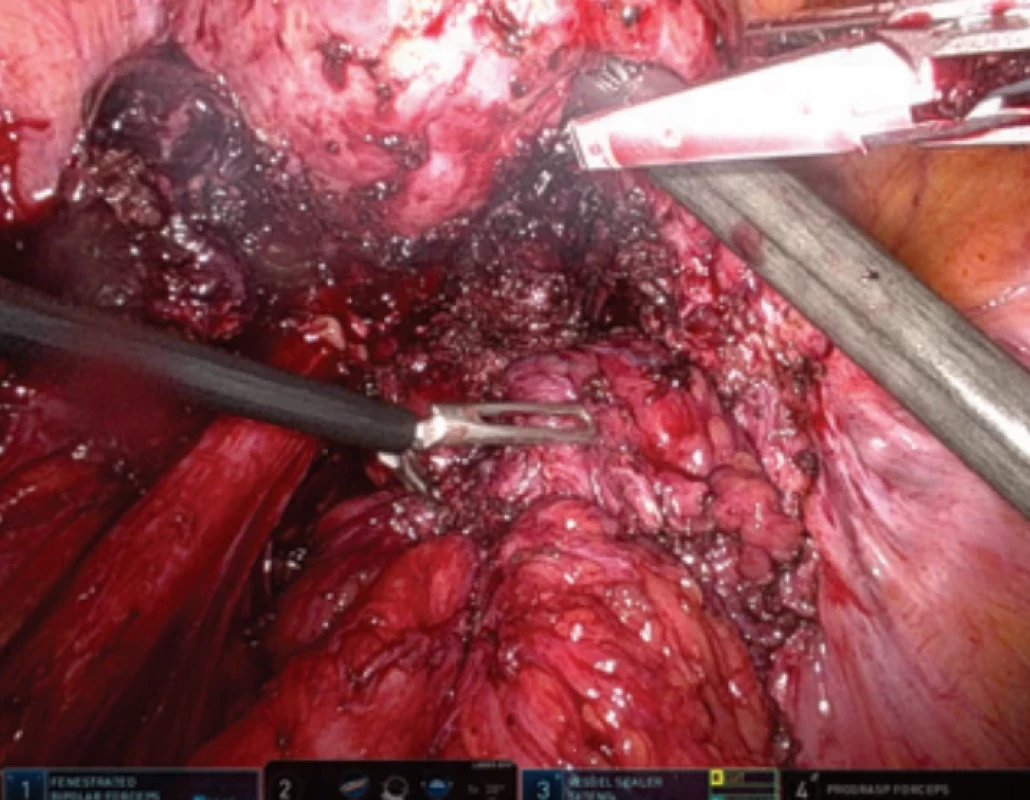 Finding after adhesiolysis before resection of the rectum. Obr. 2. Nález po uvolnění adhezí před resekcí rekta.