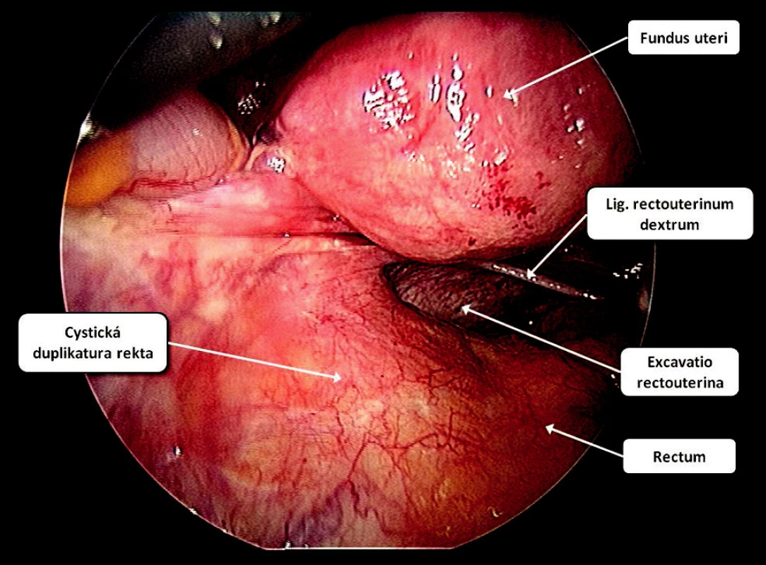 Laparoskopický pohled do malé pánve na retroperitoneálně uložený útvar o průměru 10 cm, který byl později histologicky verifikován jako cystická duplikatura rekta